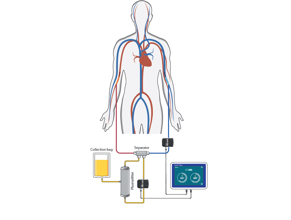 Apheresis Diagram