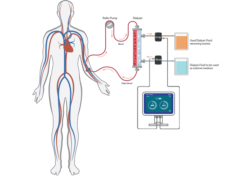 Dialysis/Hemodialysis Diagram