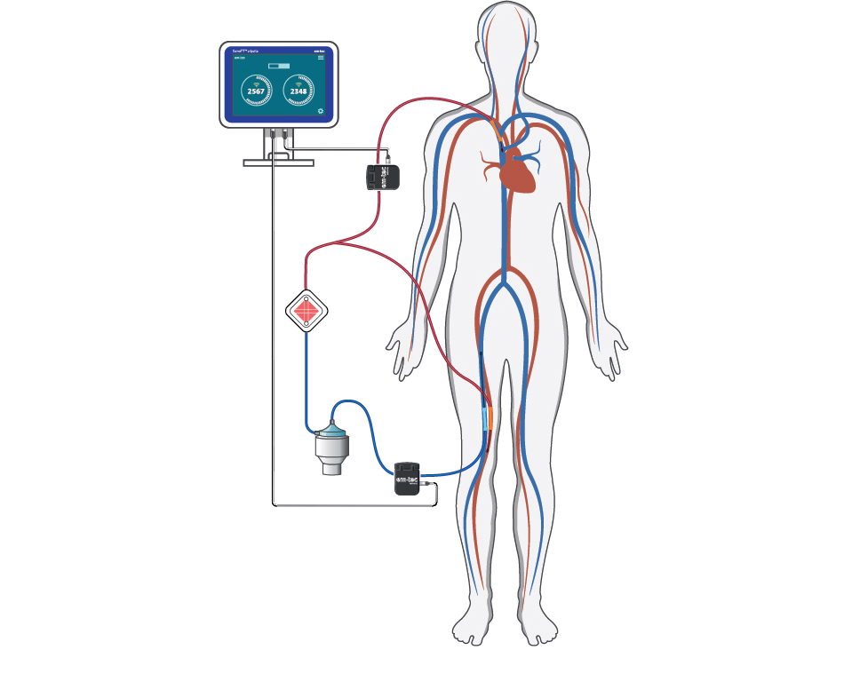 Extracorporeal Membrane Oxygenation (ECMO) Diagram